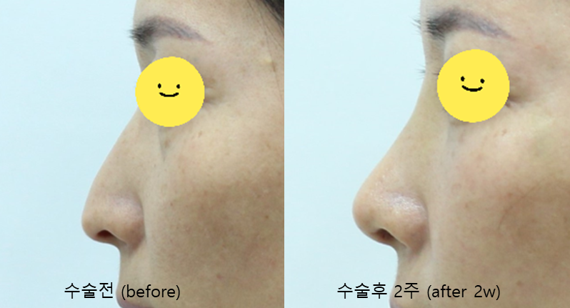 The Aging Process of the Nose and Midlife Rhinoplasty image 9