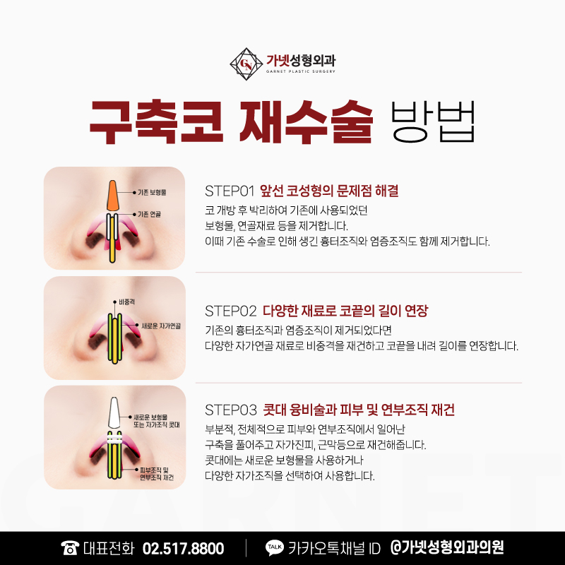 구축코재수술 잘하는병원의 재수술 성공 비결 관련 이미지 3