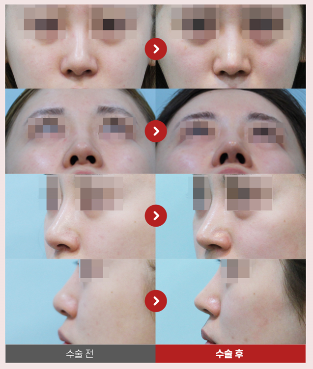 【가넷성형외과 백인수원장 성형칼럼】 휜코 무보형물 코성형 시 주의사항 관련 이미지 5