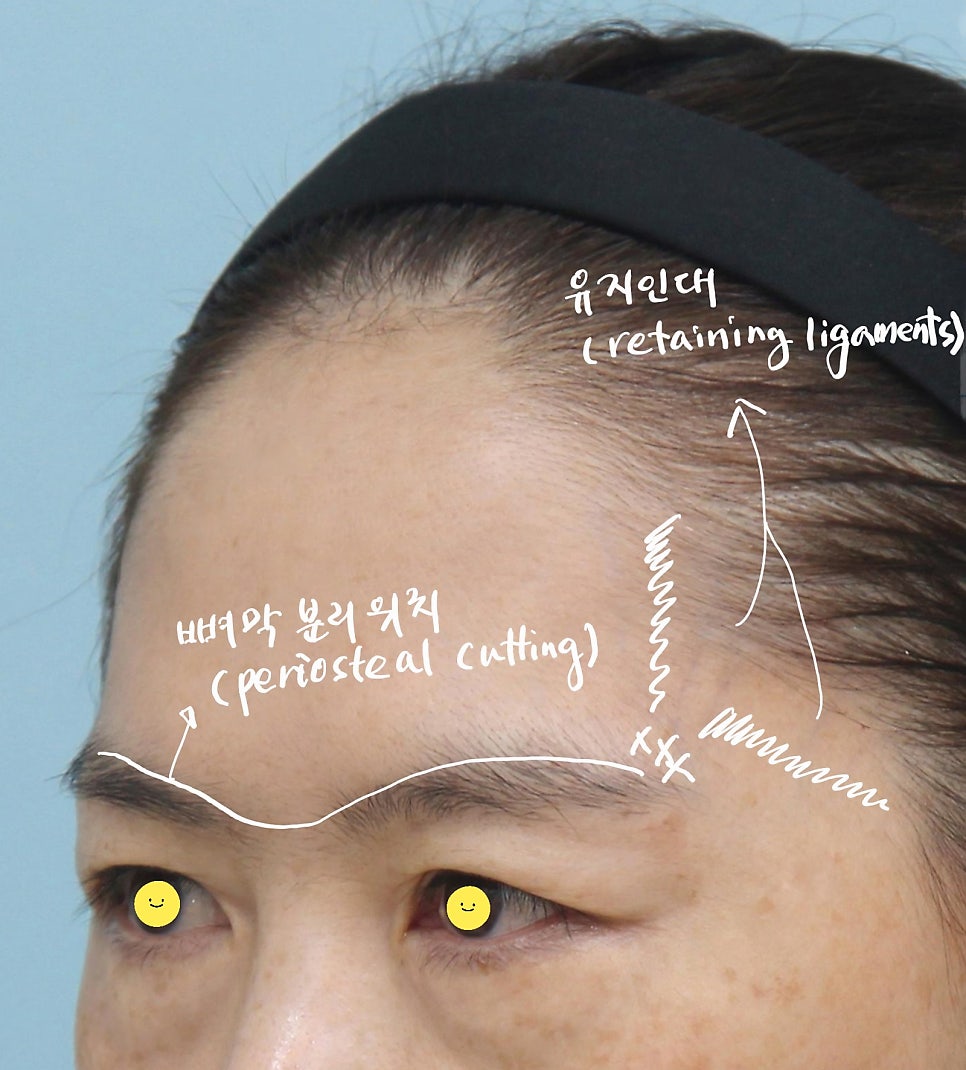 이마거상의 수술 과정 관련 이미지 6