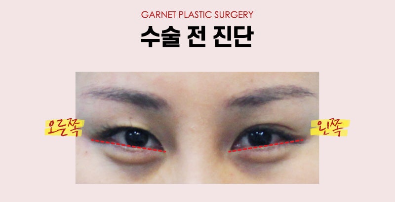【Garnet Plastic Surgery Director Baek In-soo’s Plastic Surgery Column】 Eye Correction for a Rounder, Kinder Eye Shape image 4