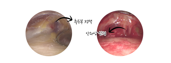 【가넷성형외과 백인수원장 성형칼럼】 펜타픽스이마거상으로 눈썹 비대칭 교정 관련 이미지 5