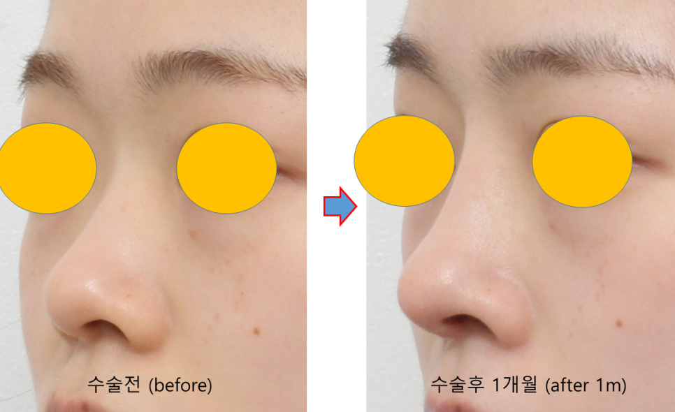 How to Naturally Enhance a Small Nose in Your First Nose Surgery image 3