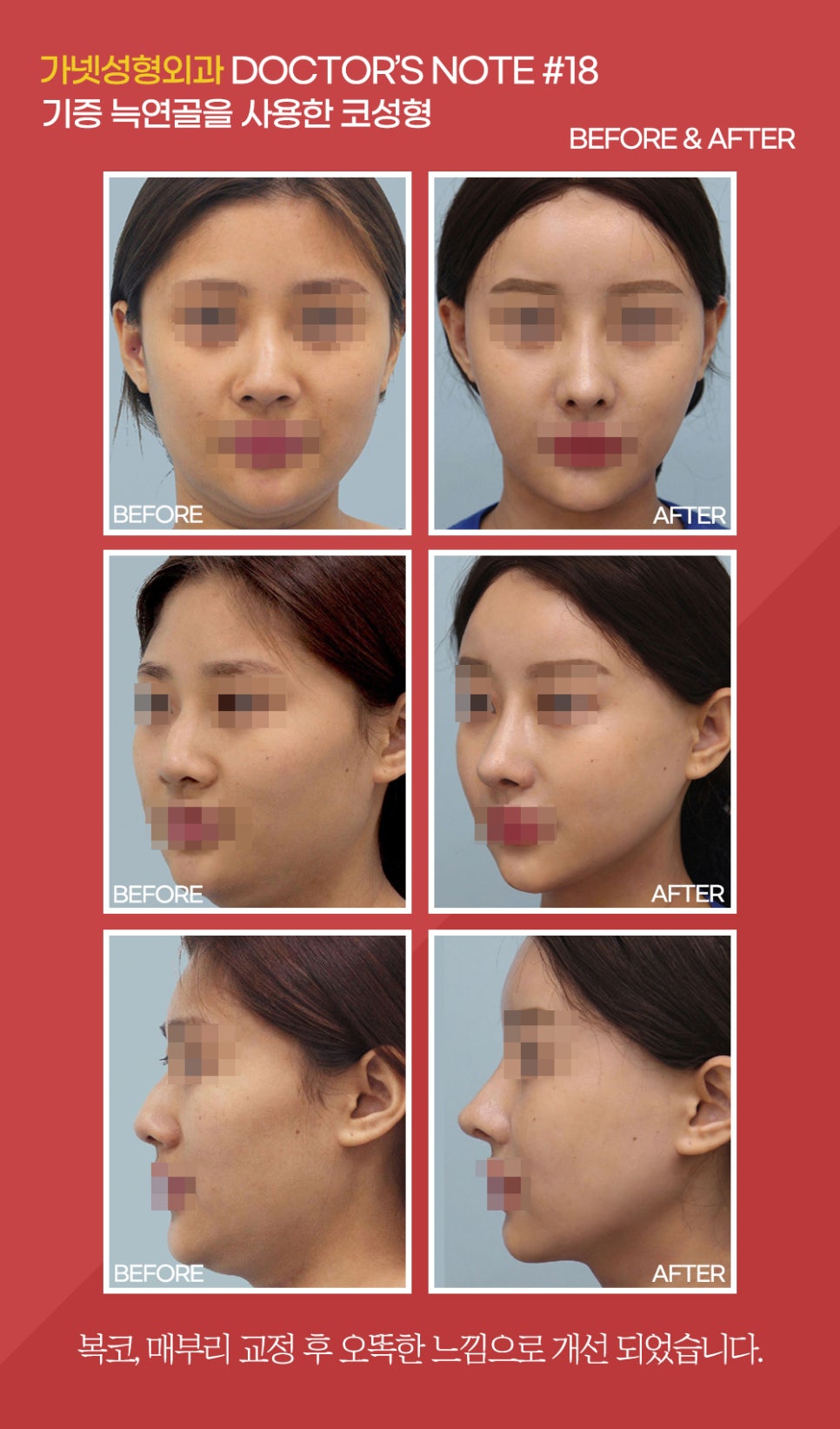 [Garnet Plastic Surgery Director Baek In-soo's Plastic Surgery Column] Rhinoplasty Using Donated Rib Cartilage image 8