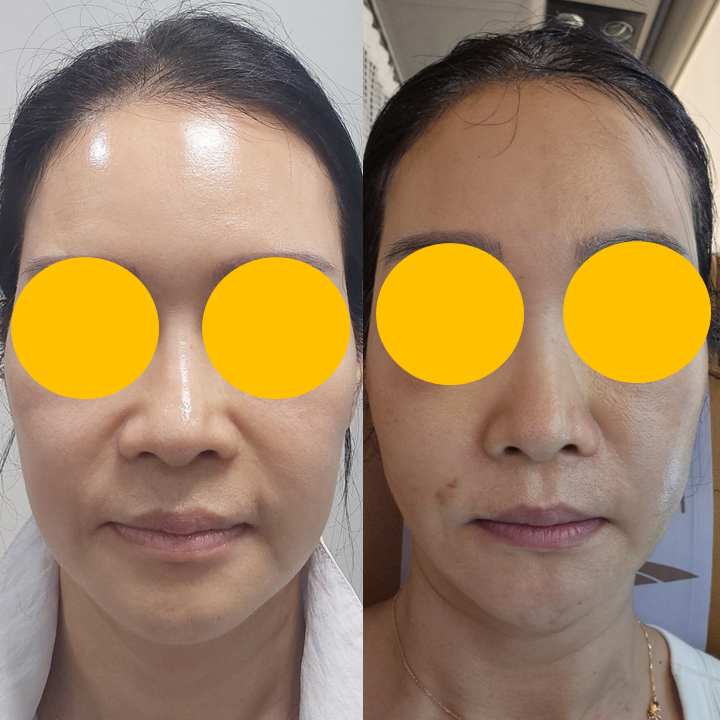 실리프팅, 어떤 실을 어떻게 사용하느냐가 중요한 이유 관련 이미지 7