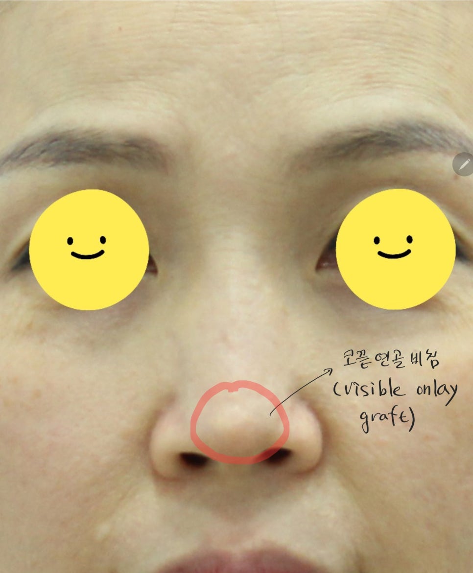 코끝연골이 비치는 경우 중년코재수술 관련 이미지 1