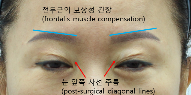 눈썹하거상술 후 상안검과 눈매교정 관련 이미지 2