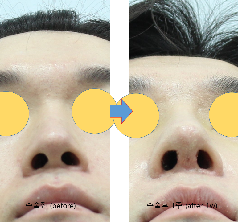 Male Rhinoplasty Performed Alongside Septoplasty image 5