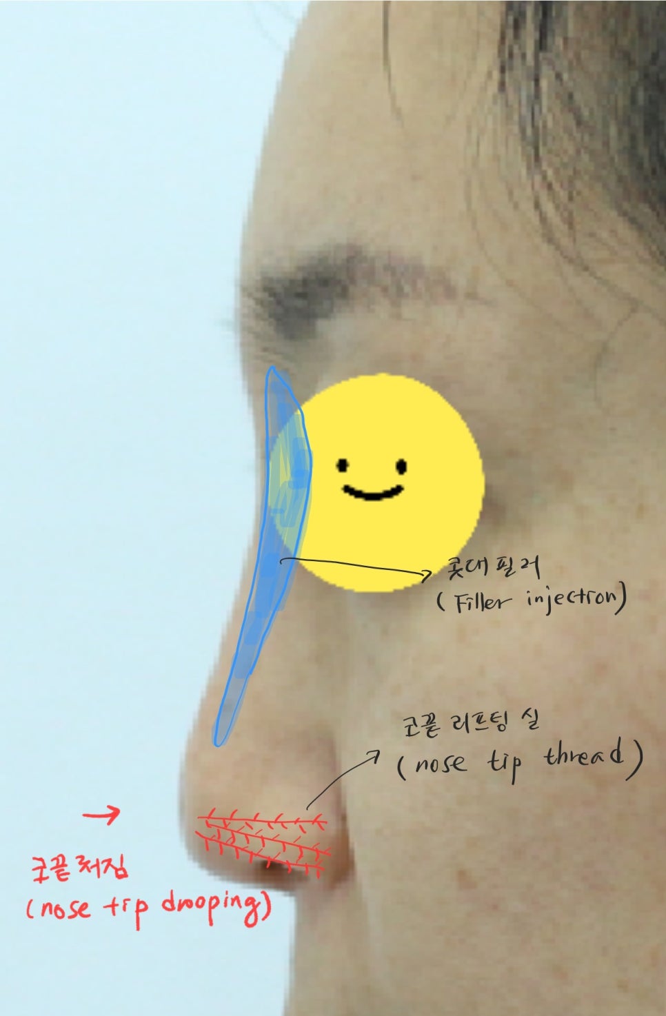 실과 필러로 높힌 코에서 발생한 염증의 치료 관련 이미지 4