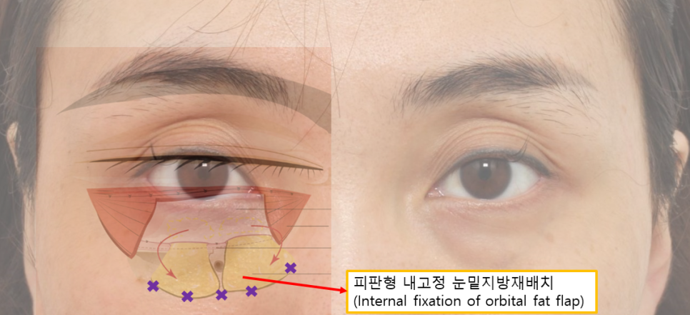 여름휴가 성형, 직장인에게 인기 있는 눈밑지방재배치(Hamra법) 관련 이미지 3