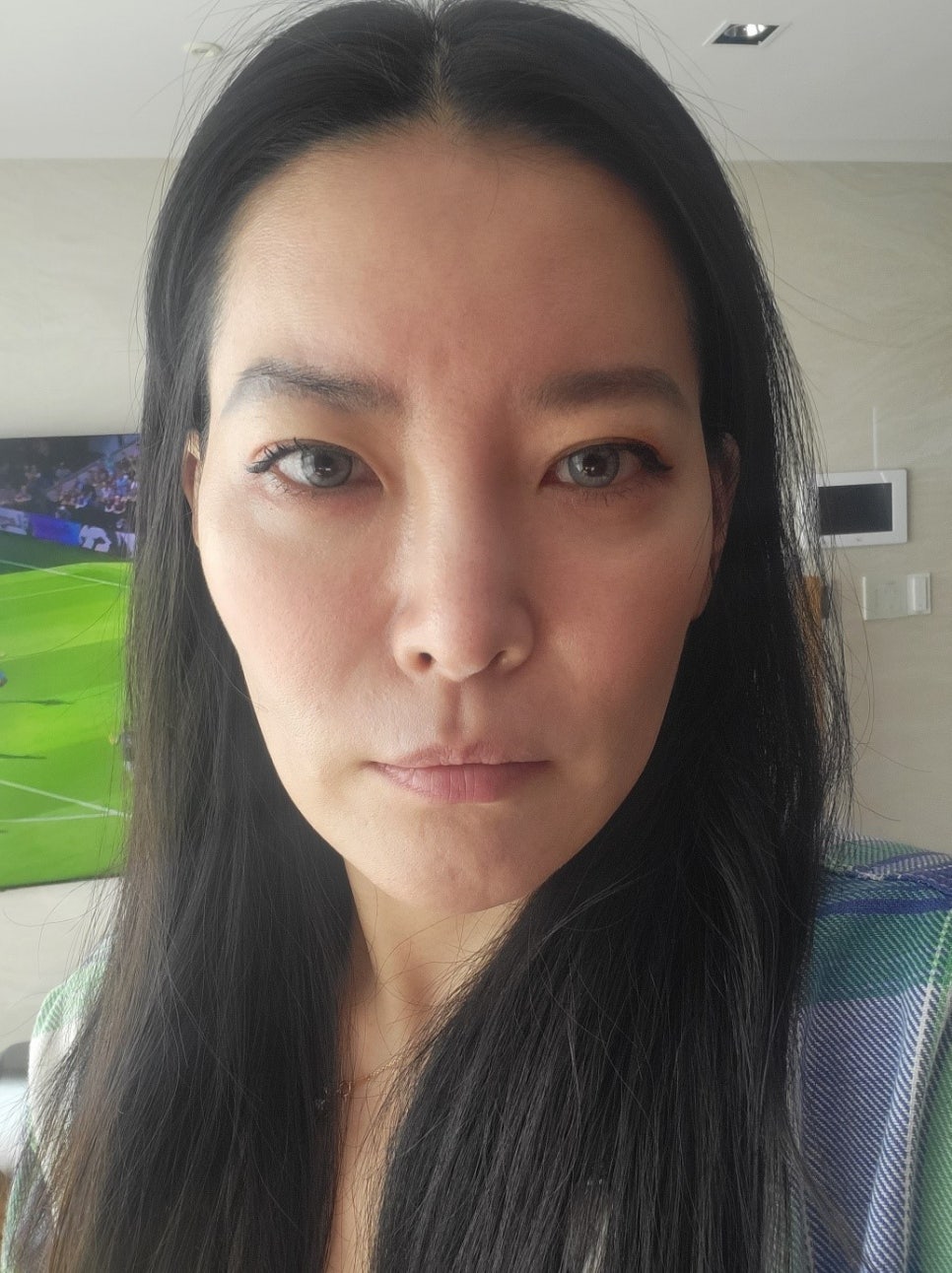 PRP Fat Grafting to Correct a Peanut-Shaped Face image 2