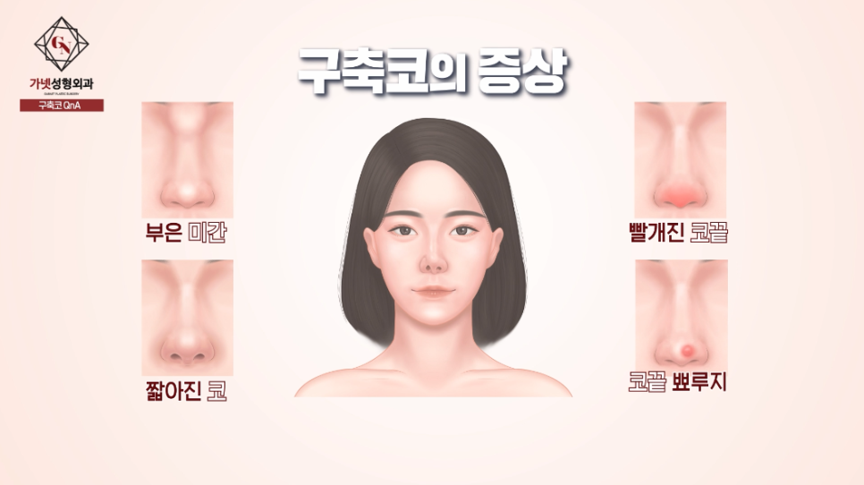 Let’s Learn Everything About Contracted Nose Revision Surgery at Garnet Plastic Surgery in Apgujeong image 2