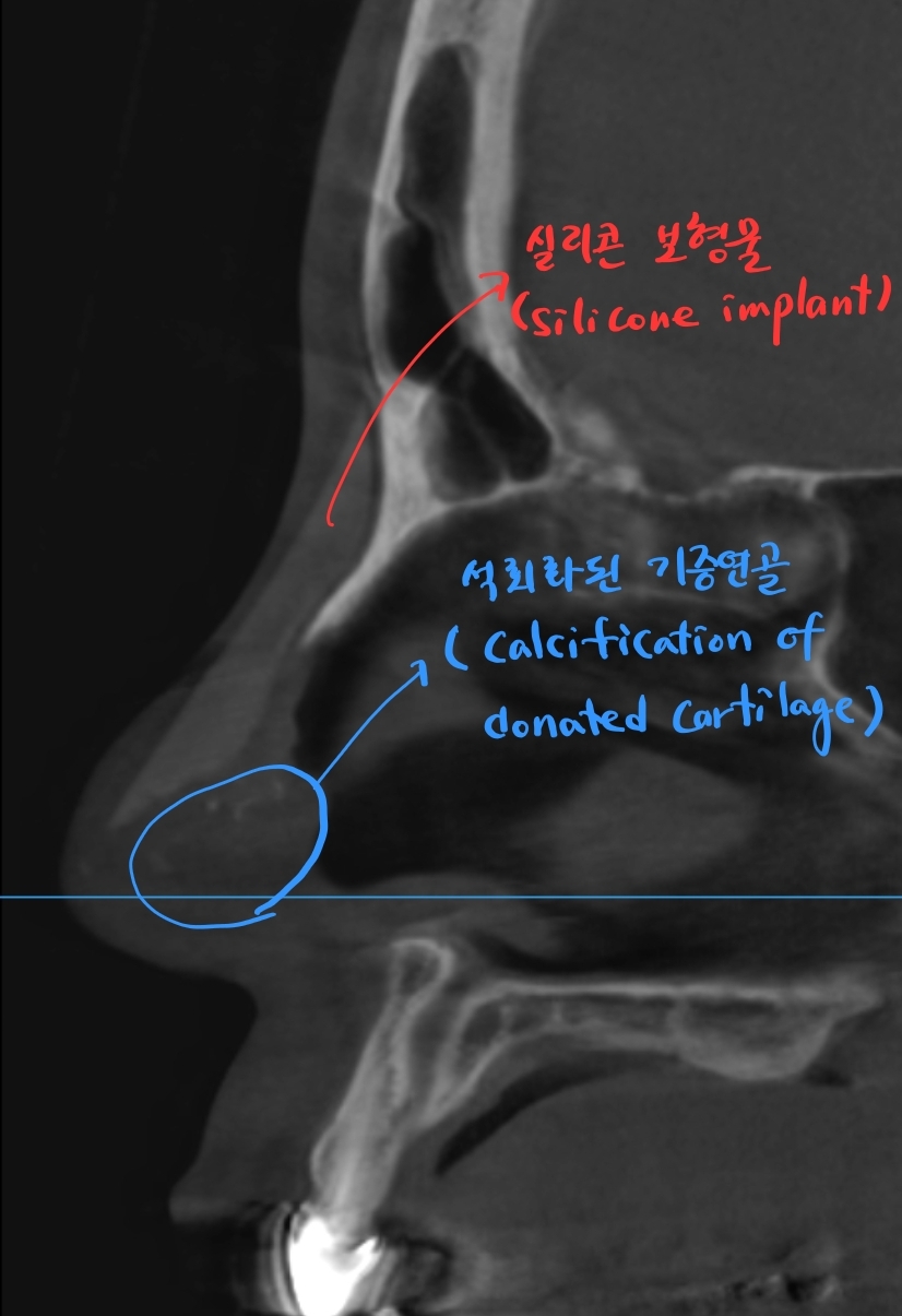 Rib Cartilage Nose Revision Surgery for Bird Beak Deformity image 2