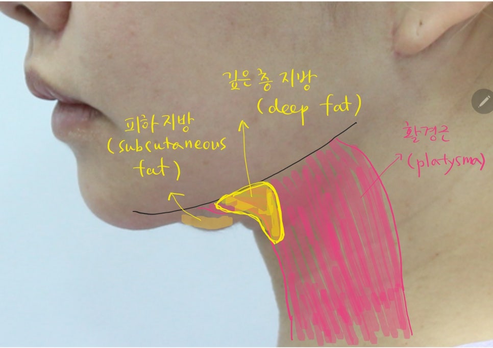 Submental Incision Neck Lift for a Deep Neck Line image 1