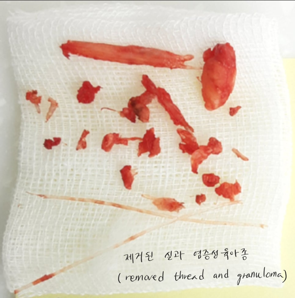 실과 필러로 높힌 코에서 발생한 염증의 치료 관련 이미지 6