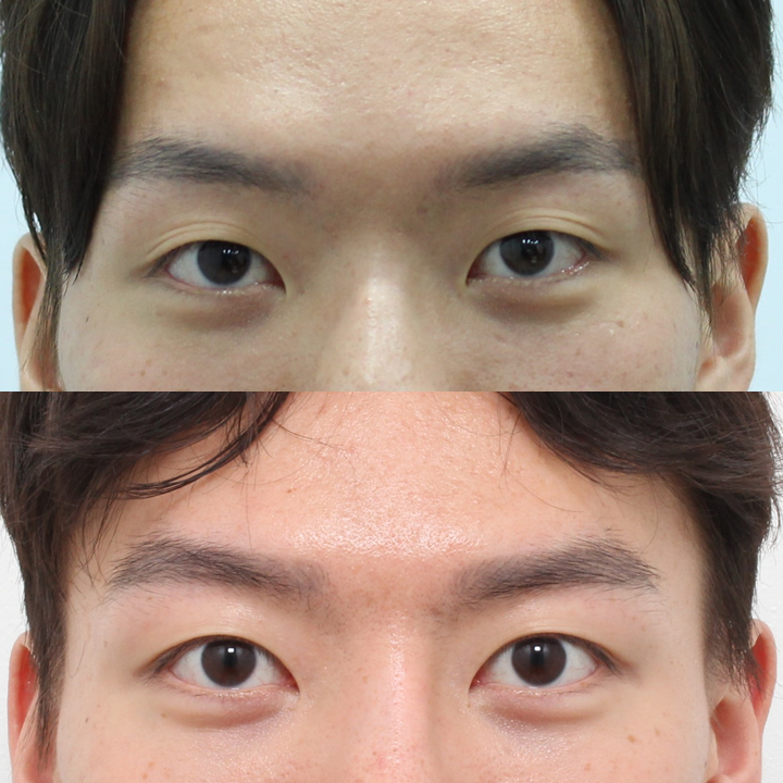 남자 비절개 쌍꺼풀과 눈매교정, 자연스러운 속쌍꺼풀을 원한다면 관련 이미지 4