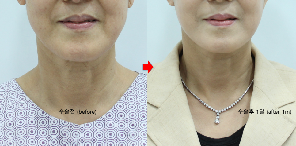 Deep Plane Facelift and Neck Lift image 5