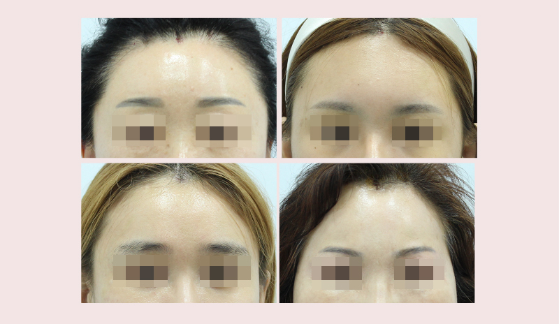 【Garnet Plastic Surgery Dr. Baek Insoo’s Plastic Surgery Column】 Fast Recovery After Pentafix Forehead Lift image 8
