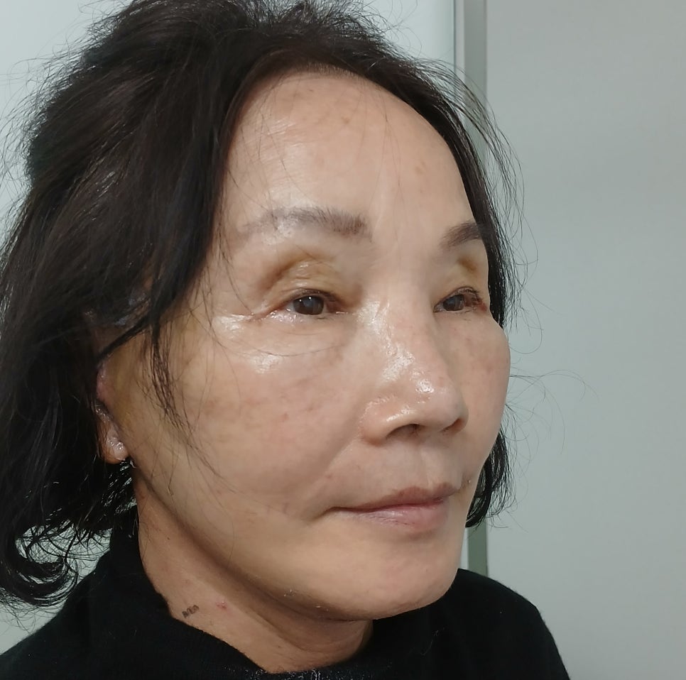 70대 안면거상 가능할까? 회복과정과 3개월 전후 실제 사례 관련 이미지 6