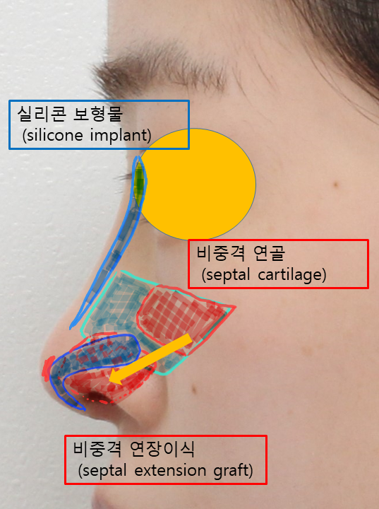 How to Naturally Enhance a Small Nose in Your First Nose Surgery image 1