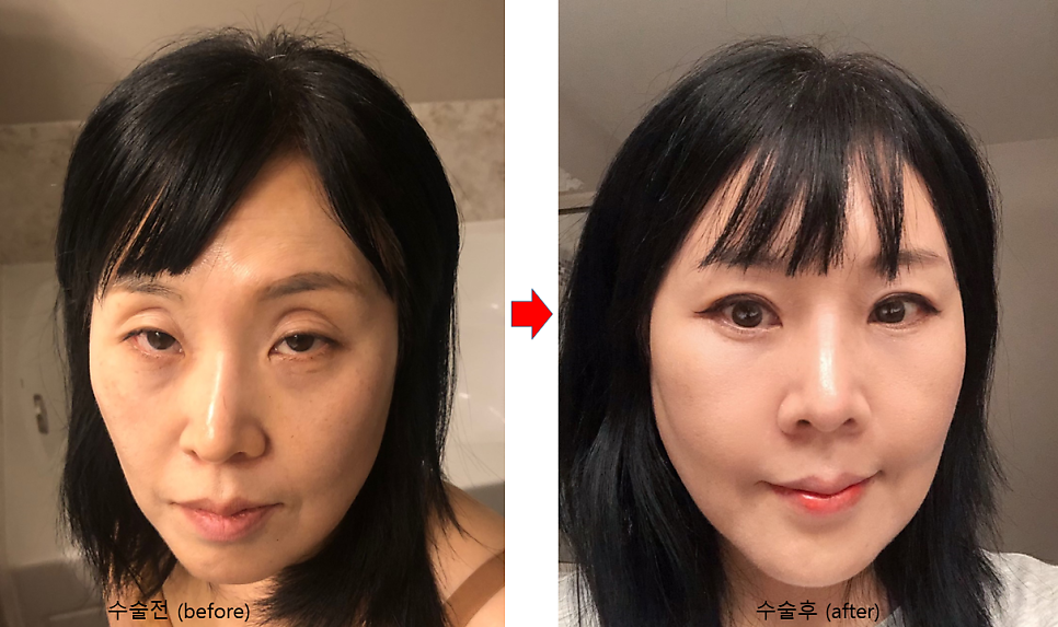 북미교포 성형수술. 해외교포(동포)성형 관련 이미지 8