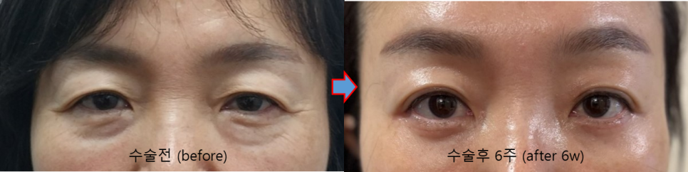 Why Horizontal Nasal Bridge Wrinkles and Eyelid Ptosis Occur Together, and the Role of Brow Lift Surgery image 4