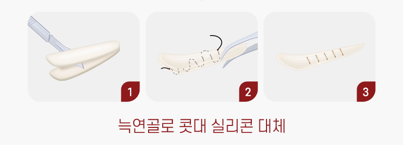 【Garnet Plastic Surgery Director Baek Insoo’s Plastic Surgery Column】 Rib Cartilage Contracted Nose Revision Surgery (Removal of Nose Implant) image 6