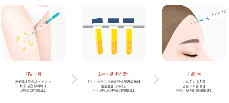 PRP Fat Grafting to Correct a Peanut-Shaped Face image 3