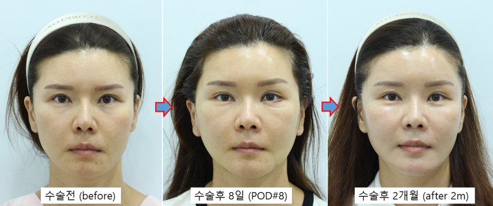 40대 후반 눈밑성형, 꼭 하안검일까? 눈밑지방재배치로 해결한 이유 관련 이미지 2