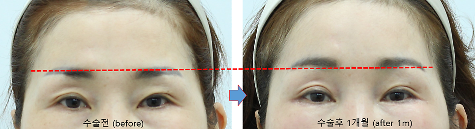 The Effect of Forehead Lift Surgery on the Eyes image 5