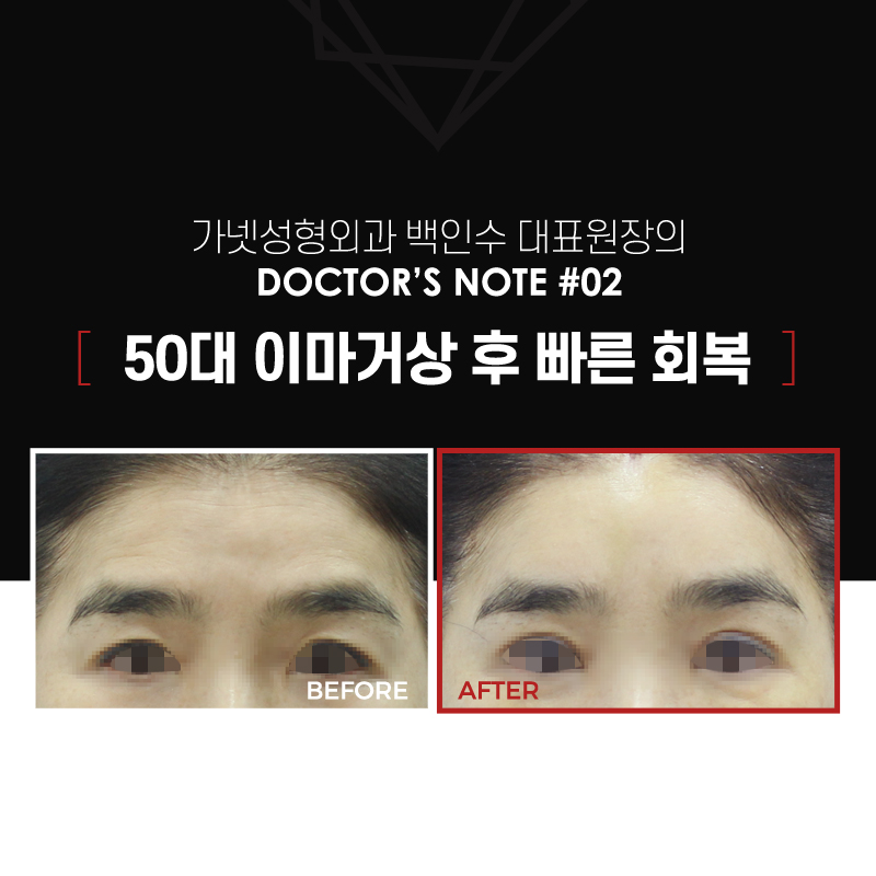 【가넷성형외과 백인수원장 성형칼럼】 50대 여성 이마거상 후 빠른 회복 관련 이미지 2