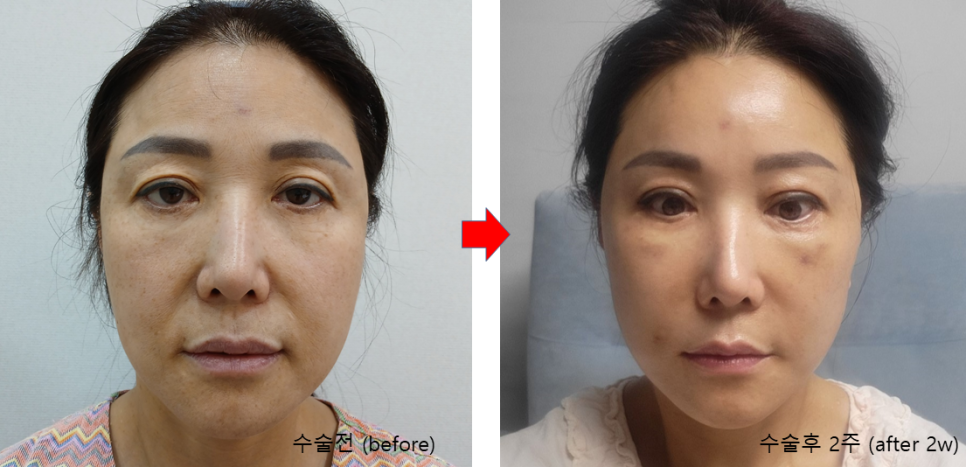 Hyperbaric Oxygen Therapy for Faster Recovery After Plastic Surgery image 7