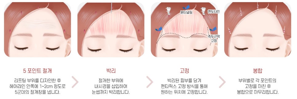 【가넷성형외과 백인수원장 성형칼럼】 20대 여성 펜타픽스 이마거상으로 이마 모양과 눈썹 교정 관련 이미지 5