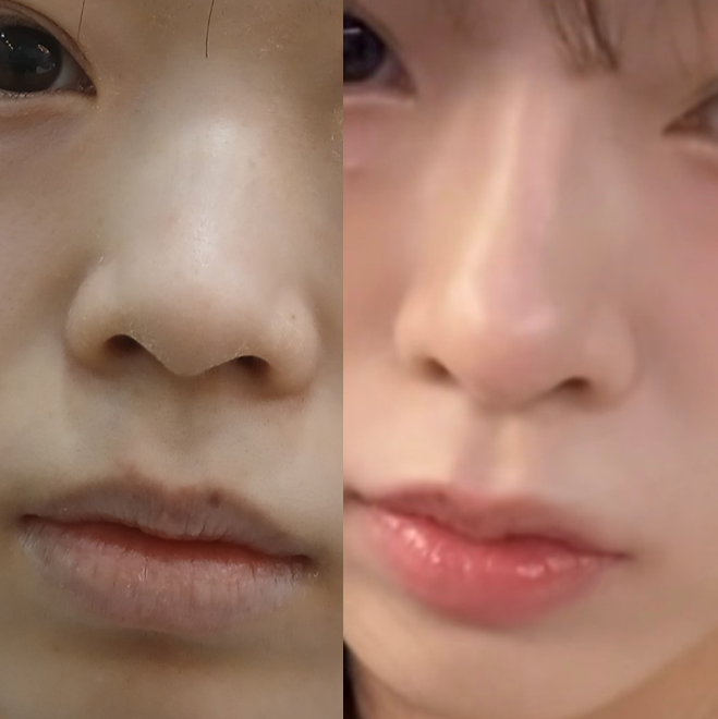 How to Naturally Enhance a Small Nose in Your First Nose Surgery image 5