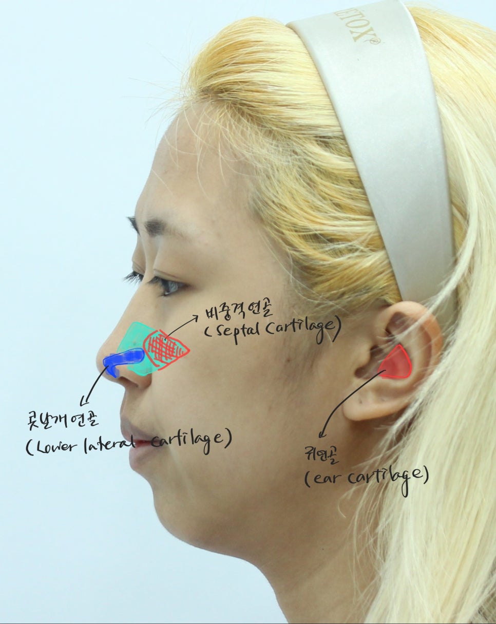 첫번째 코성형, 첫코성형, 20대 코성형 관련 이미지 3
