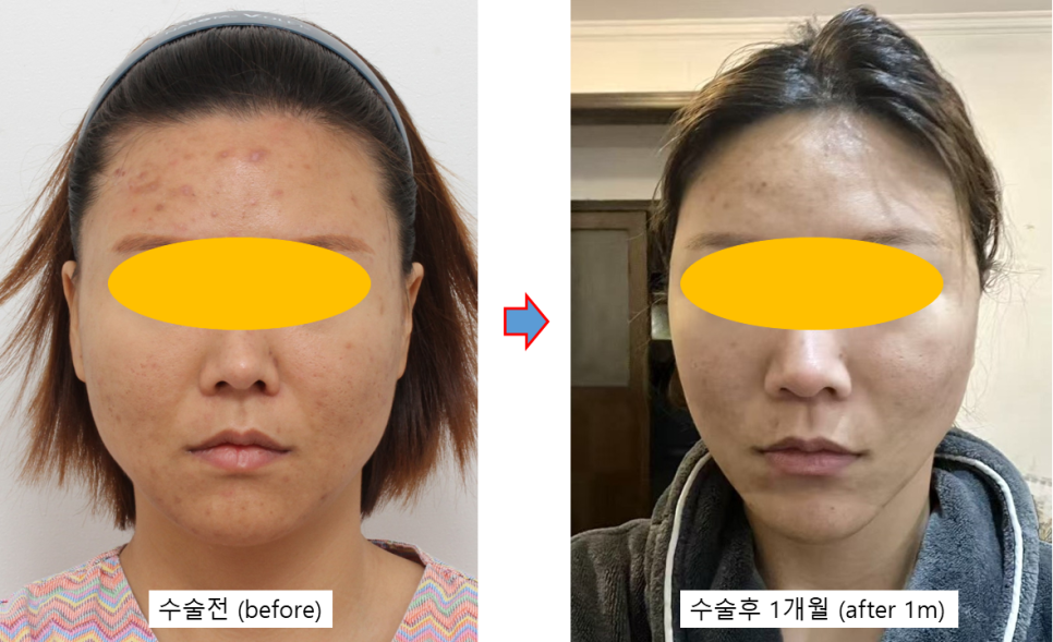 미니거상의 진화, MACS에서 딥미니거상(MADE)까지 관련 이미지 4