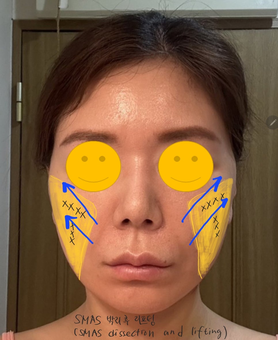 Causes of Nasolabial Folds and How to Address Them image 6