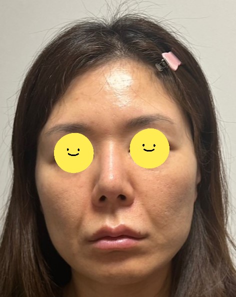Swelling the Day After a Facelift image 1