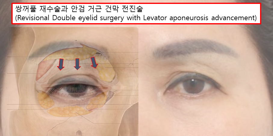 복합적인 눈 문제, 하나의 수술보다 원인별 교정이 중요한 이유 관련 이미지 3