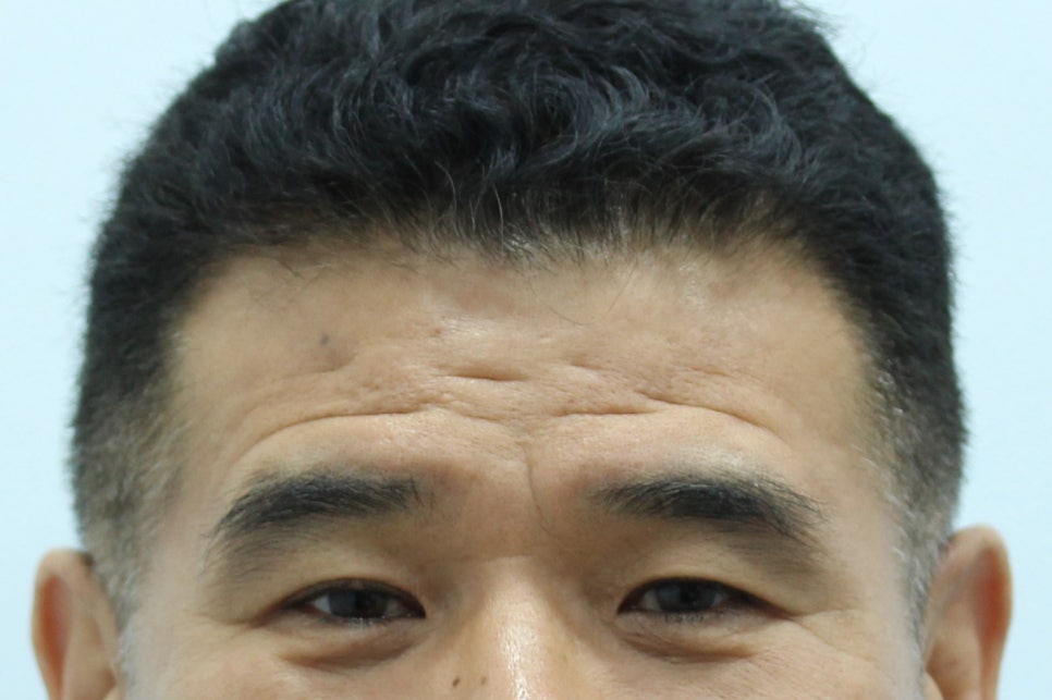 중년 남자 이마거상 수술의 과정 관련 이미지 1