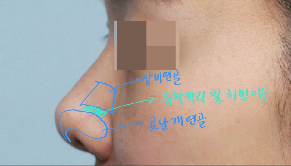 Lengthening Revision Rhinoplasty for a Short, Upturned Nose image 3