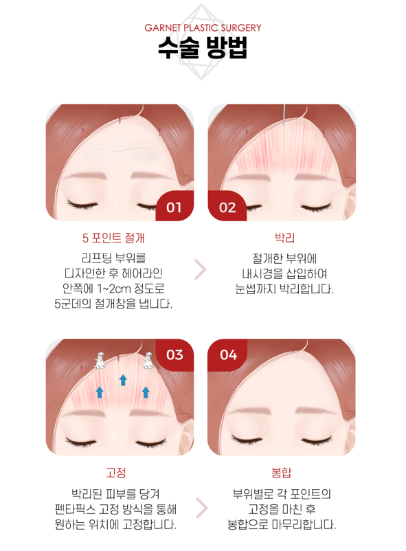 【가넷성형외과 백인수원장 성형칼럼】 펜타픽스이마거상으로 눈썹 비대칭 교정 관련 이미지 4