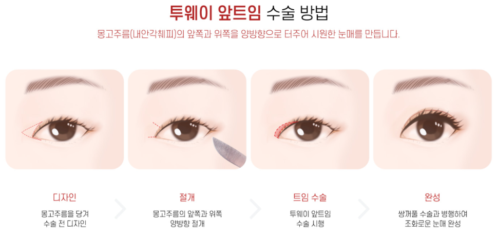 앞트임 재수술에서 윗트임의 중요성 관련 이미지 5