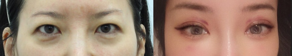 Choosing a Surgical Method for Upper Eyelid Skin Sagging image 9