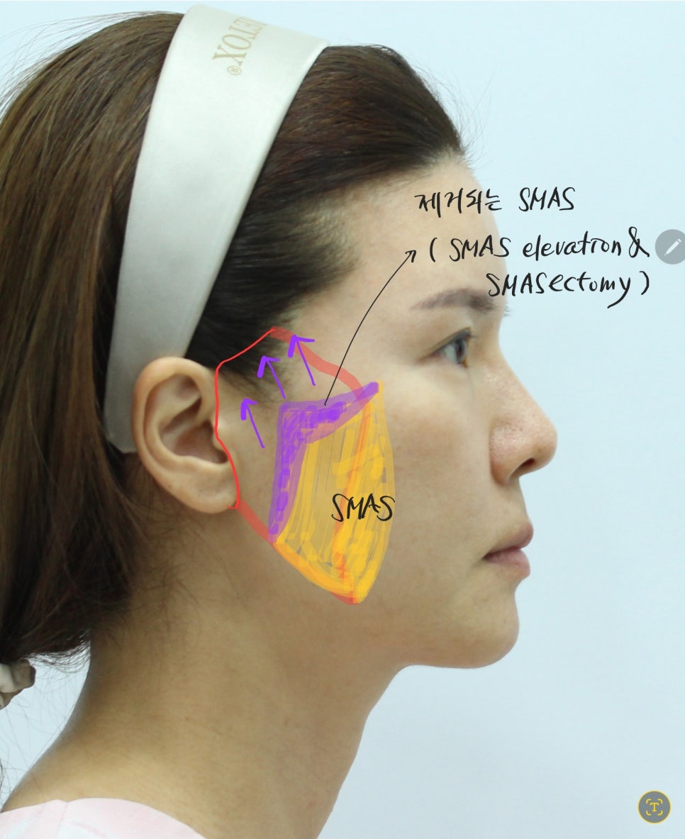 Correcting Cheek Sagging and Sunken Cheeks After Facial Contouring Surgery image 5