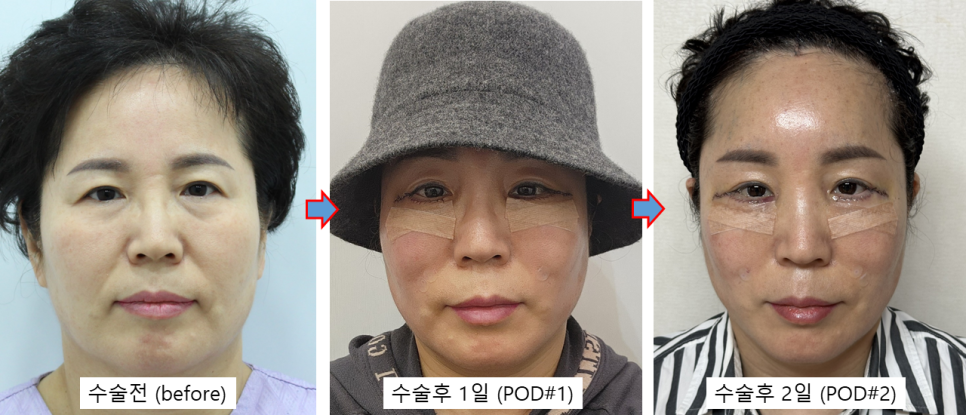 Mother’s Day Top Pick for a Gratitude-Driven Facial Procedure: The Recovery Process After Lower Blepharoplasty A to Z image 1