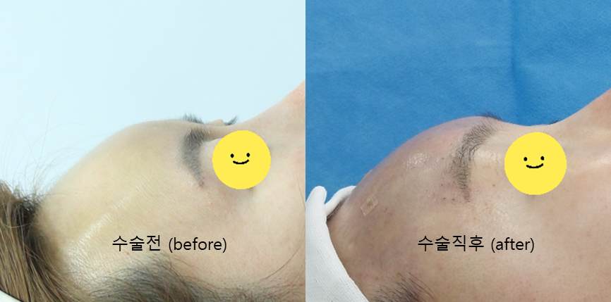 내시경을 이용한 최소절개 이마 보형물 제거 관련 이미지 10