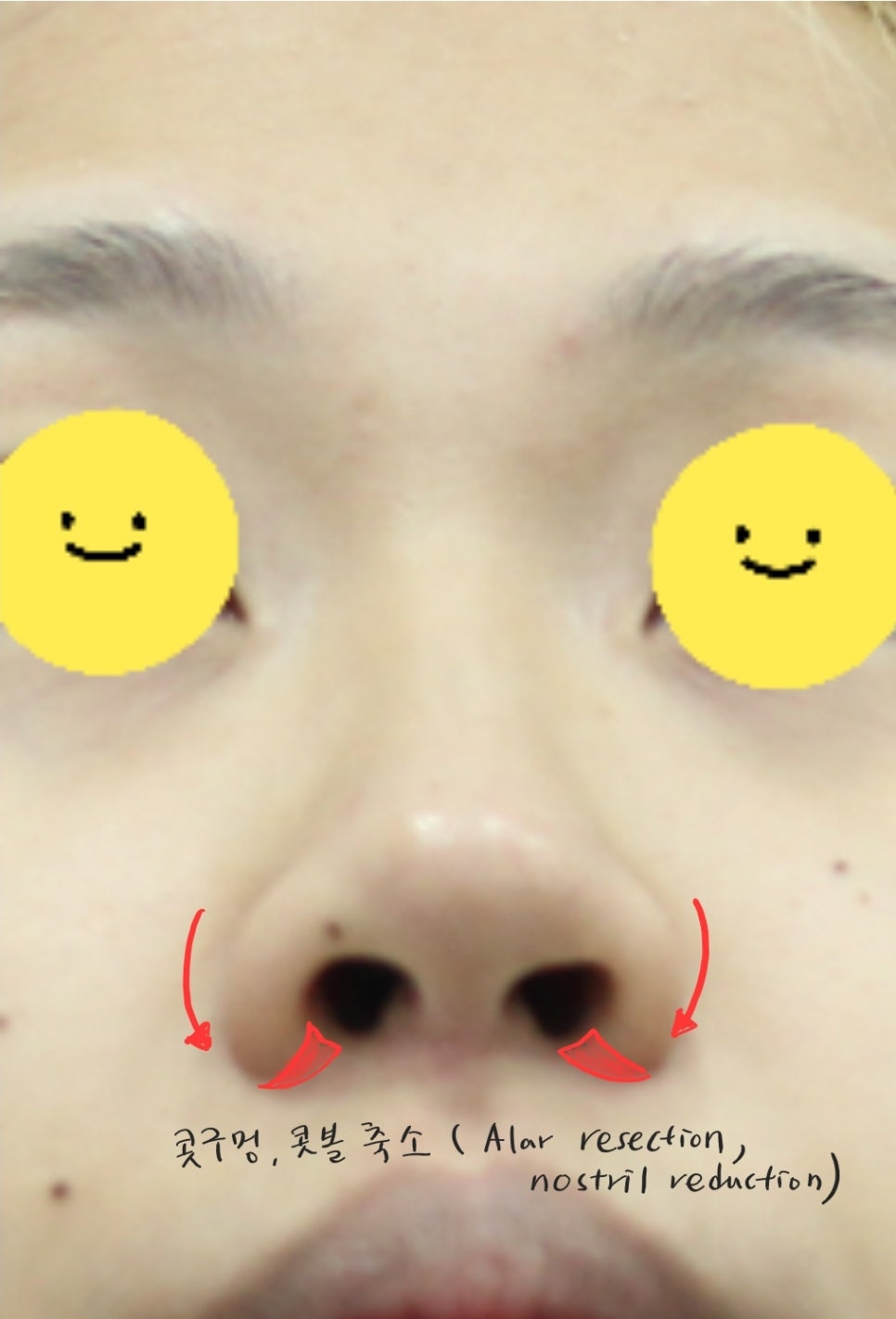 Two Methods of Nostril Reduction (Alar Reduction) image 3