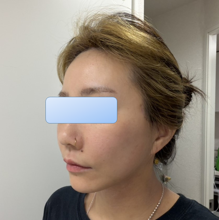 A Deep Mini Facelift Case for a Japanese Patient Who Was Disappointed with the Longevity of Thread Lifting image 6