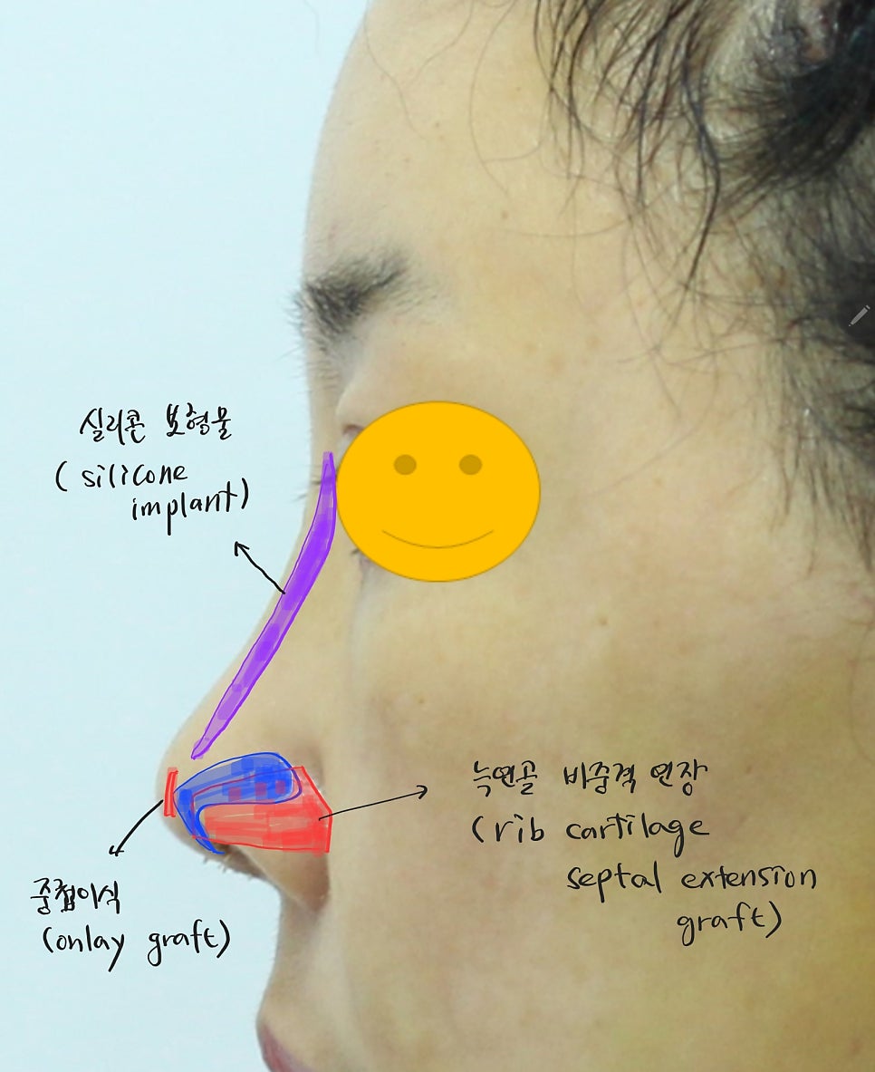 Checking the Size of the Septal Cartilage with a CT Scan Before Revision Nose Surgery image 6